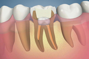 Complication-Calciffed Canal Curved Root